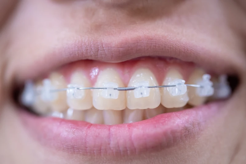 Orthodontics /braces/invisible braces Servicse