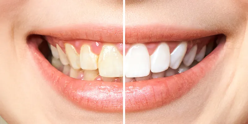 Teeth Whitening/Bleaching Servicse