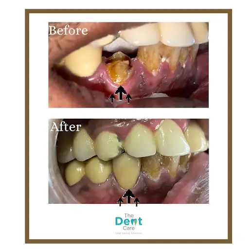 dental_crown