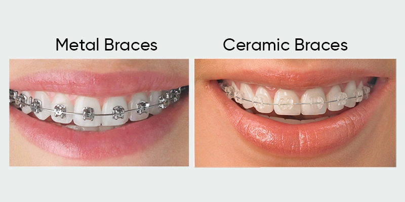 Orthodontics /braces/invisible braces Servicse